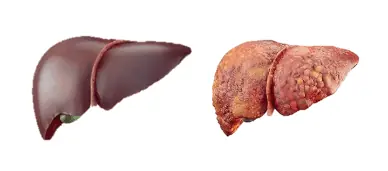 Hígado normal VS hígado graso